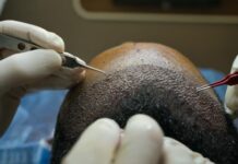 השתלות שיער לגברים: הפתרון המושלם לשיער מלא ובריא