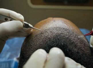 השתלות שיער לגברים: הפתרון המושלם לשיער מלא ובריא